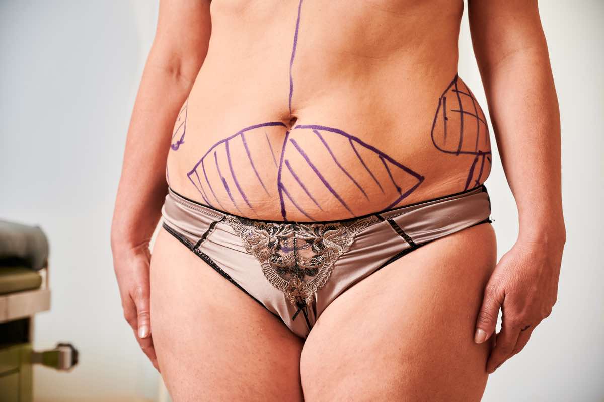 Abdominoplàstia transformadora.